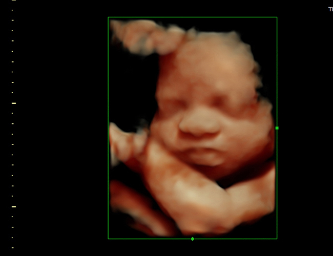 3D ultrasound image at 29 weeks